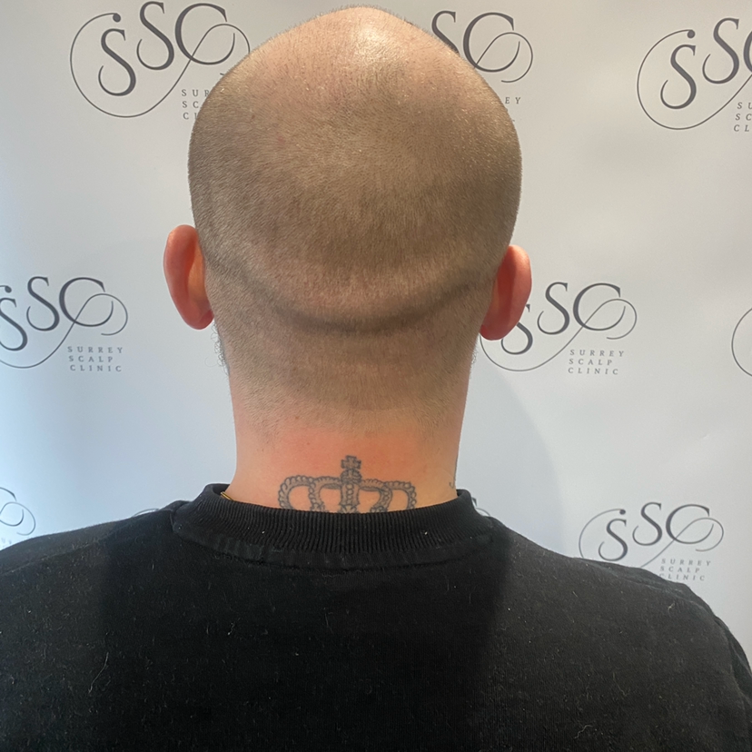 PHOTO GALLERY | Surrey Scalp Clinic